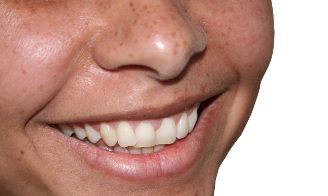Wybielanie zębów: metody domowe i dentystyczne